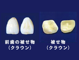 前歯の被せ物（クラウン）・被せ物（クラウン）