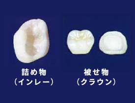 詰め物（インレー）・被せ物（クラウン）