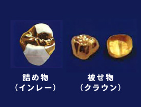 ゴールド 詰め物（インレー）・被せ物（クラウン）
