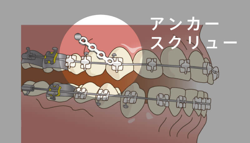 アンカースクリュー