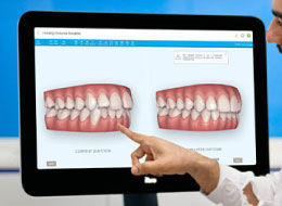 インビザライン検査(クリンチェック)