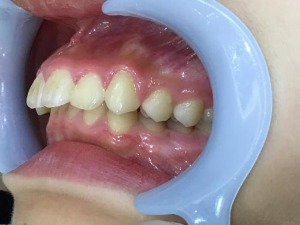 症例集　インビザライン　左横