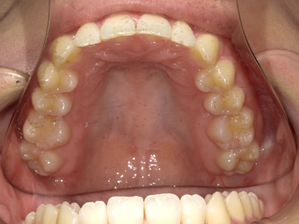 症例集　インビザライン　上顎