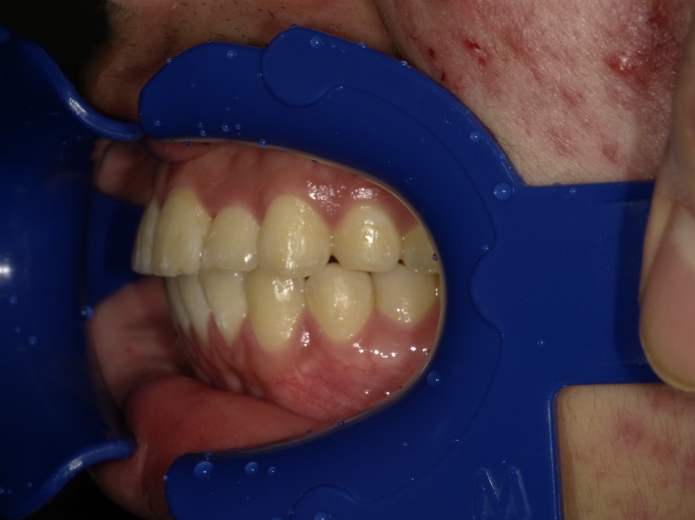 症例集　インビザライン　左横