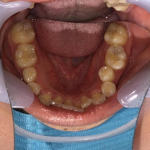 症例集　インビザライン　下顎
