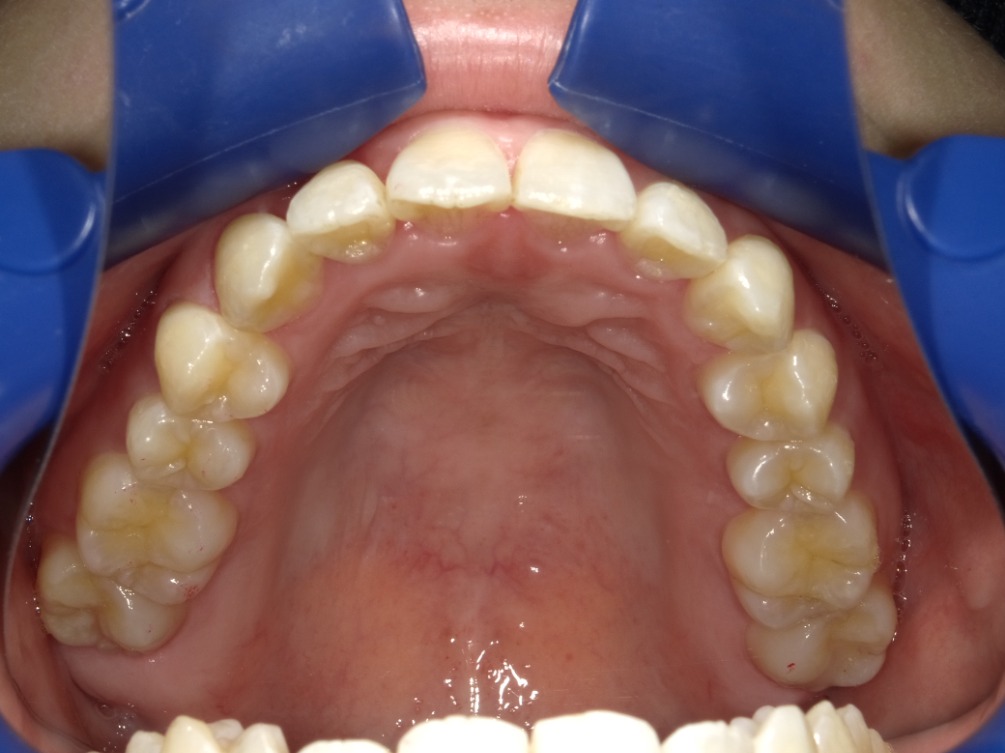 症例集　インビザライン　上顎