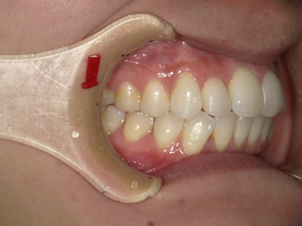 症例集　インビザライン　右横