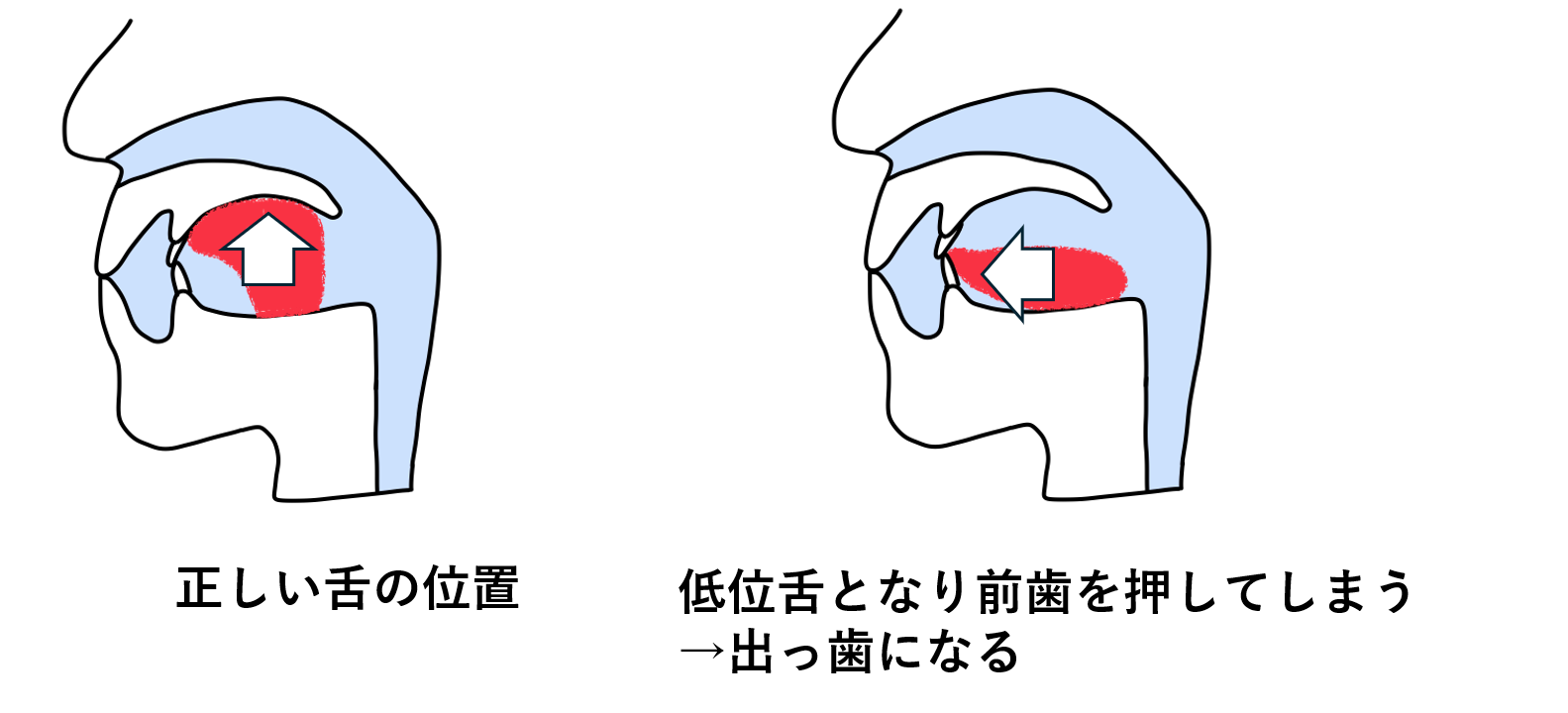 舌の正しい位置