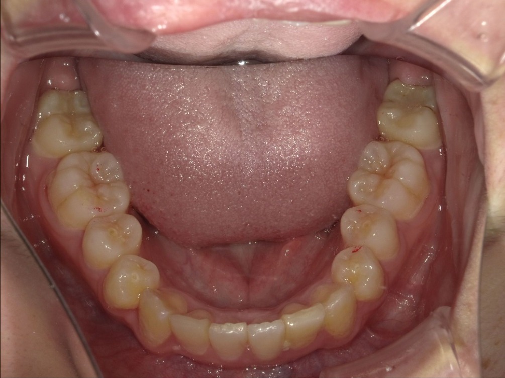 症例集　インビザライン　下顎
