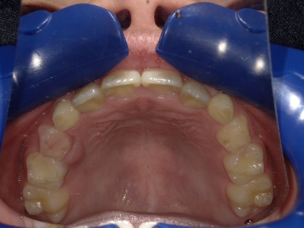 症例集　インビザライン　上顎
