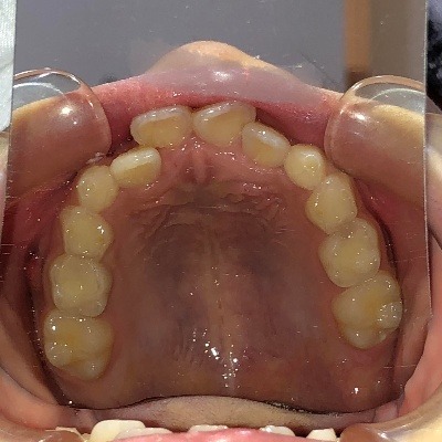 症例集　インビザライン　上顎