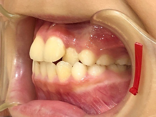 症例集　インビザライン　左横