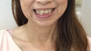 症例集　インビザライン　笑顔