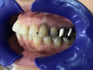 症例集　インビザライン　左横