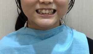 症例集　インビザライン　笑顔