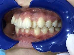 症例集　インビザライン　左横