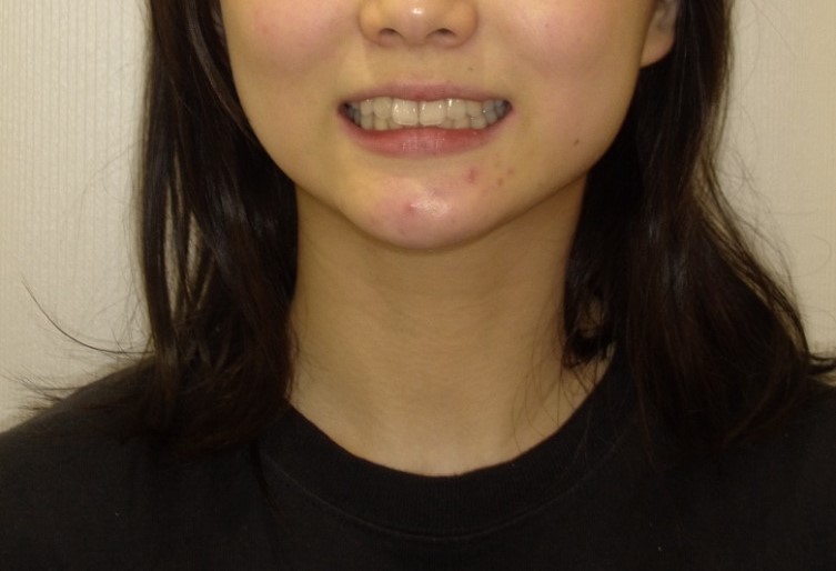 症例集　インビザライン　笑顔