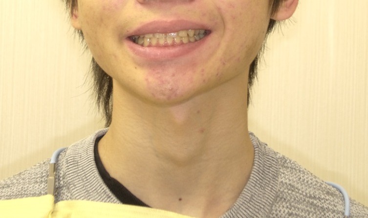 症例集　インビザライン　笑顔