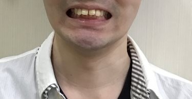 症例集　インビザライン　笑顔