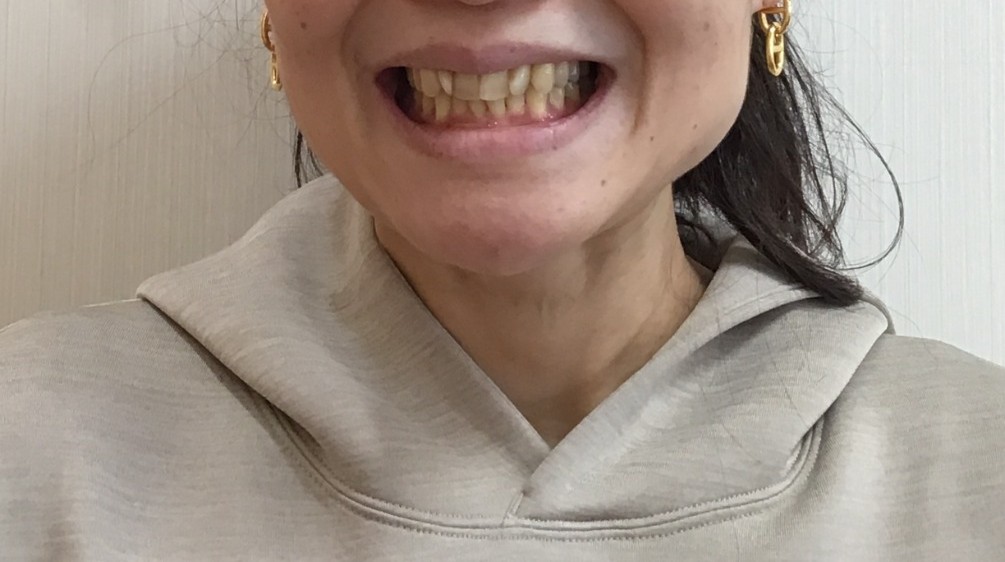 症例集　インビザライン　笑顔