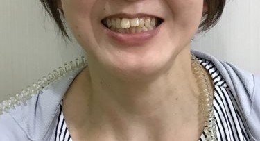 症例集　インビザライン　笑顔