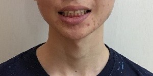 症例集　インビザライン　笑顔