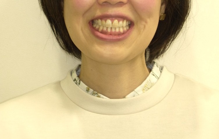 症例集　インビザライン　笑顔