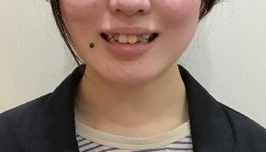 症例集　インビザライン　笑顔