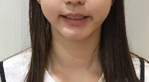 症例集　インビザライン　笑顔