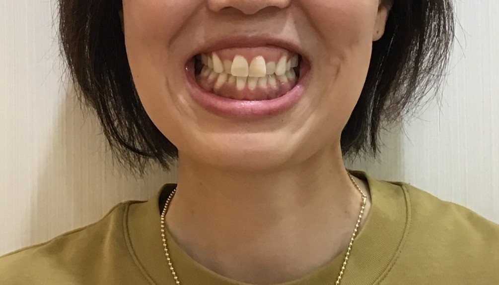 症例集　インビザライン　笑顔