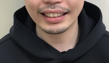 症例集　インビザライン　笑顔