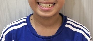 症例集　インビザライン　笑顔