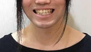 症例集　インビザライン　笑顔