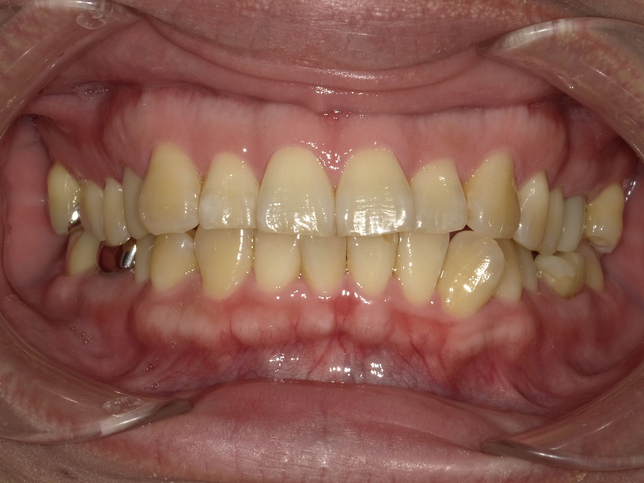 症例集　デュアルホワイトニング