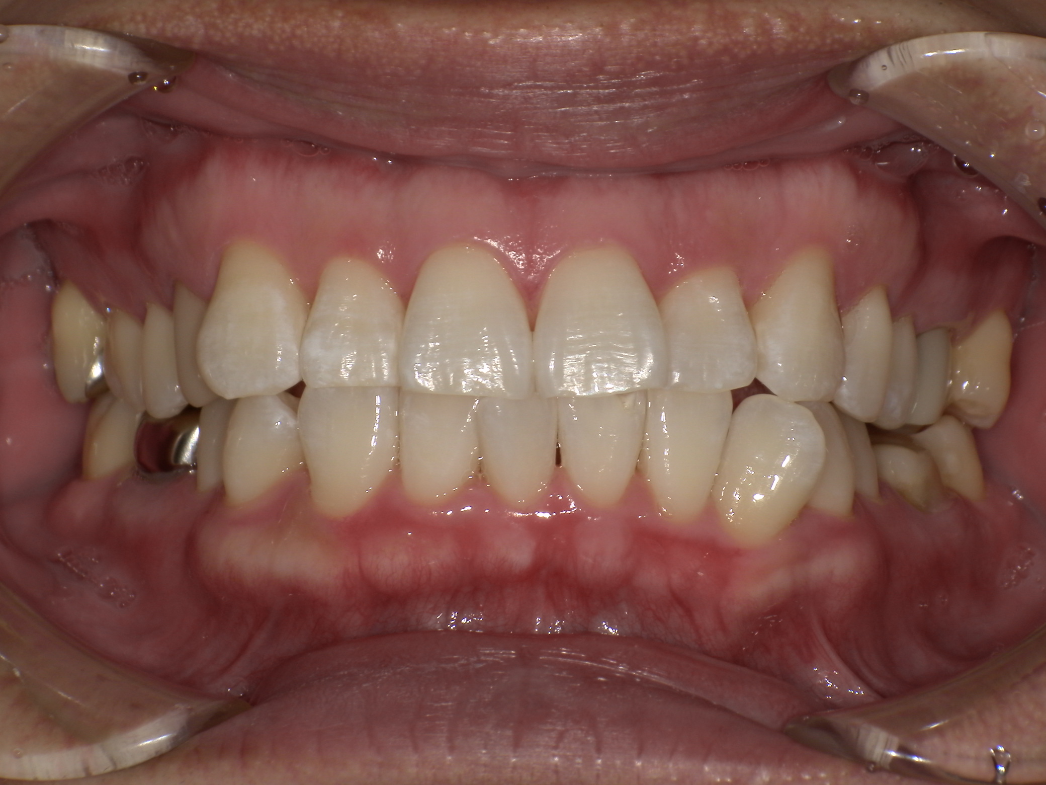 症例集　デュアルホワイトニング