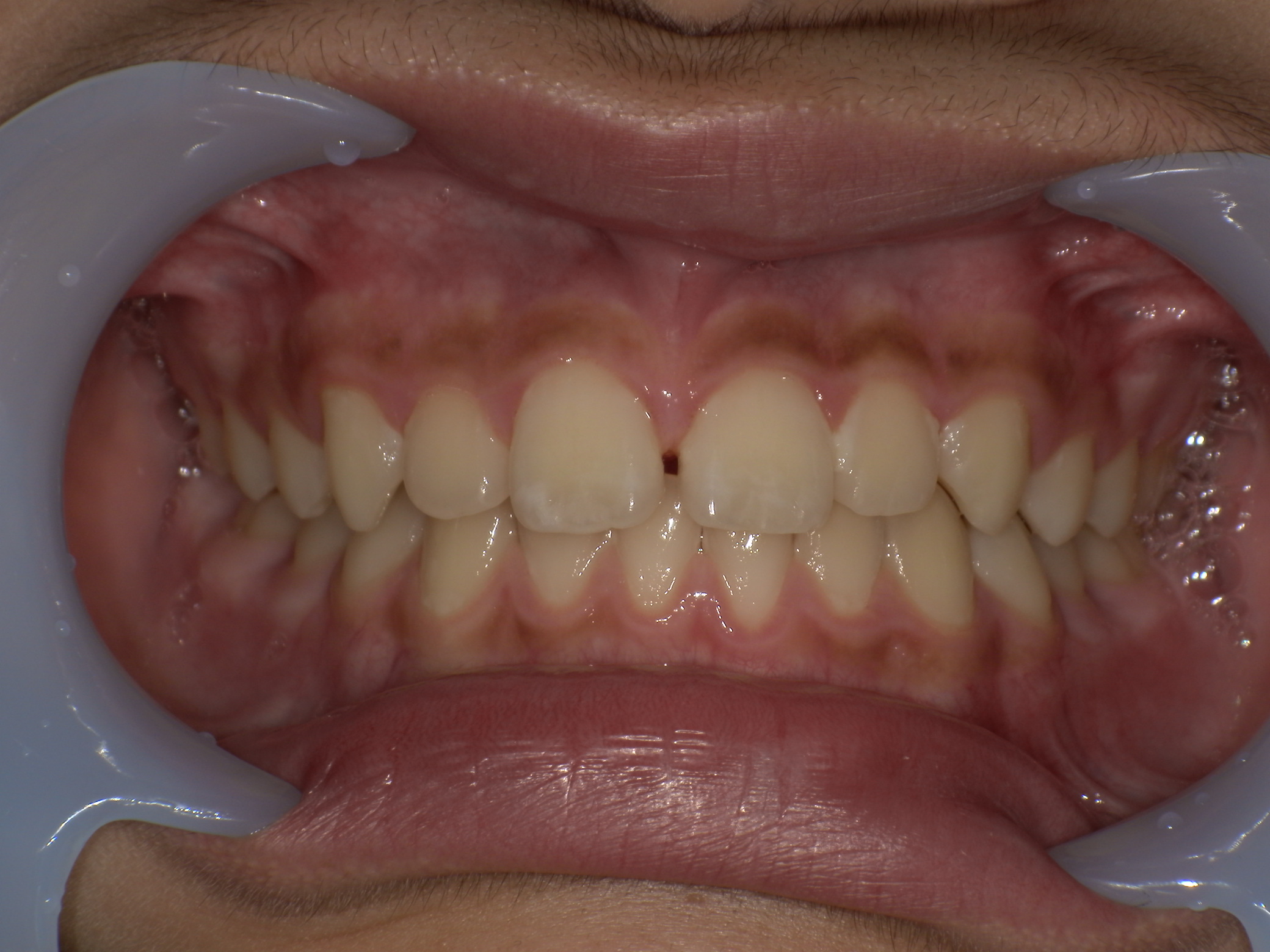 症例集　予防矯正　正面