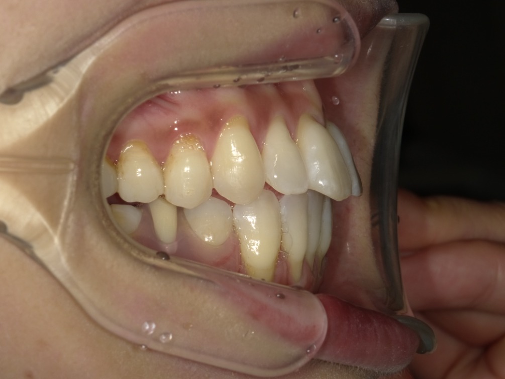 症例集 インビザライン 右横