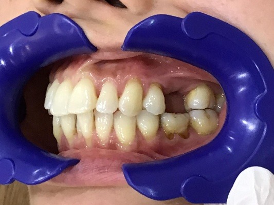 症例集 インビザライン 左横