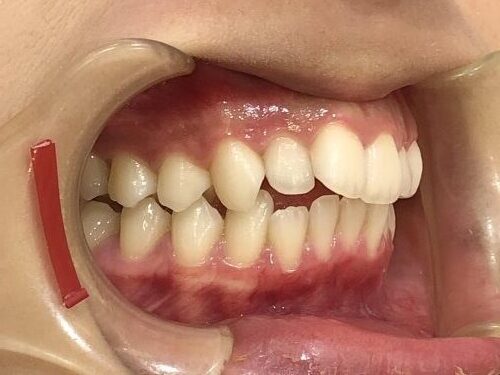 症例集 インビザライン 右横