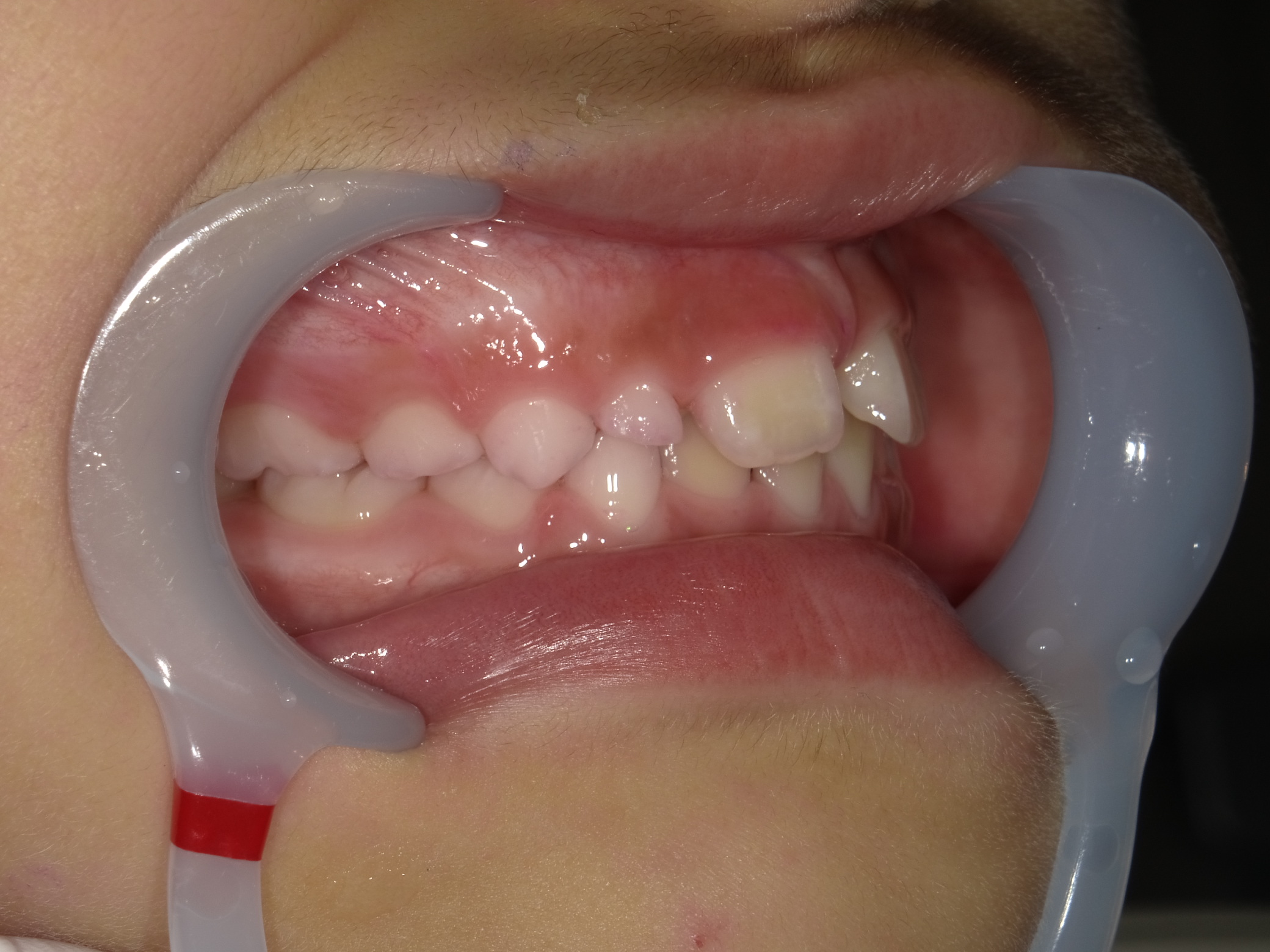 症例集　予防矯正　右横