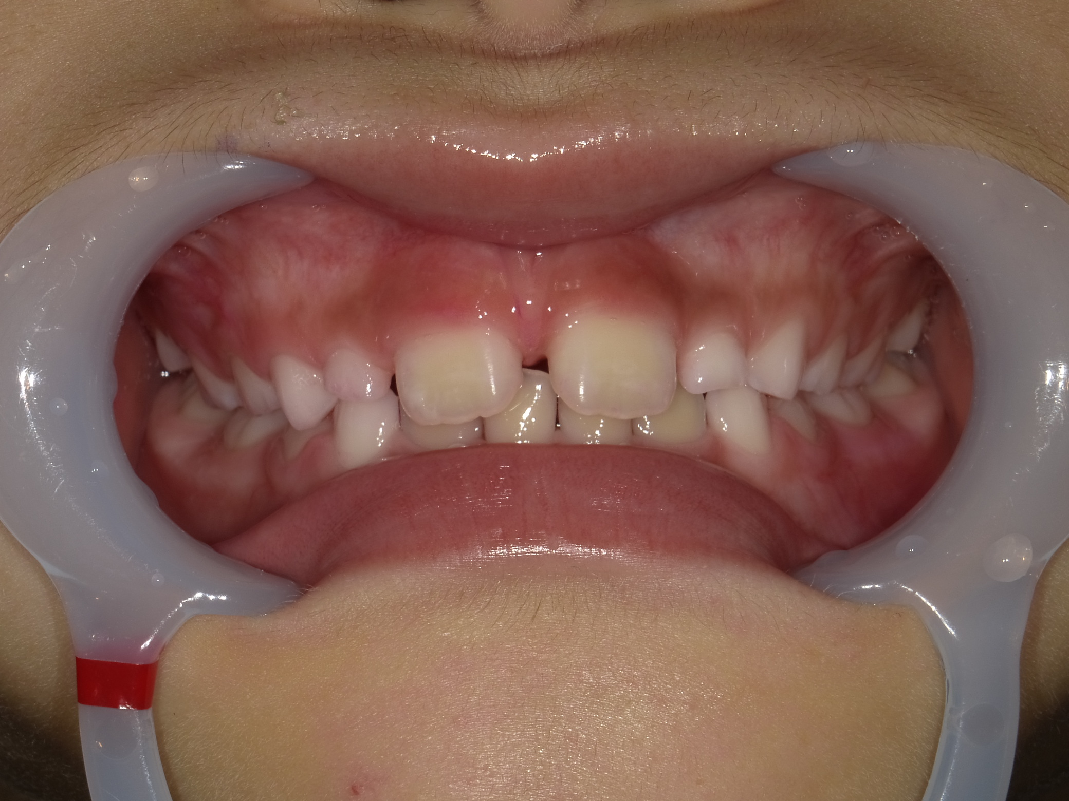 症例集　予防矯正　正面