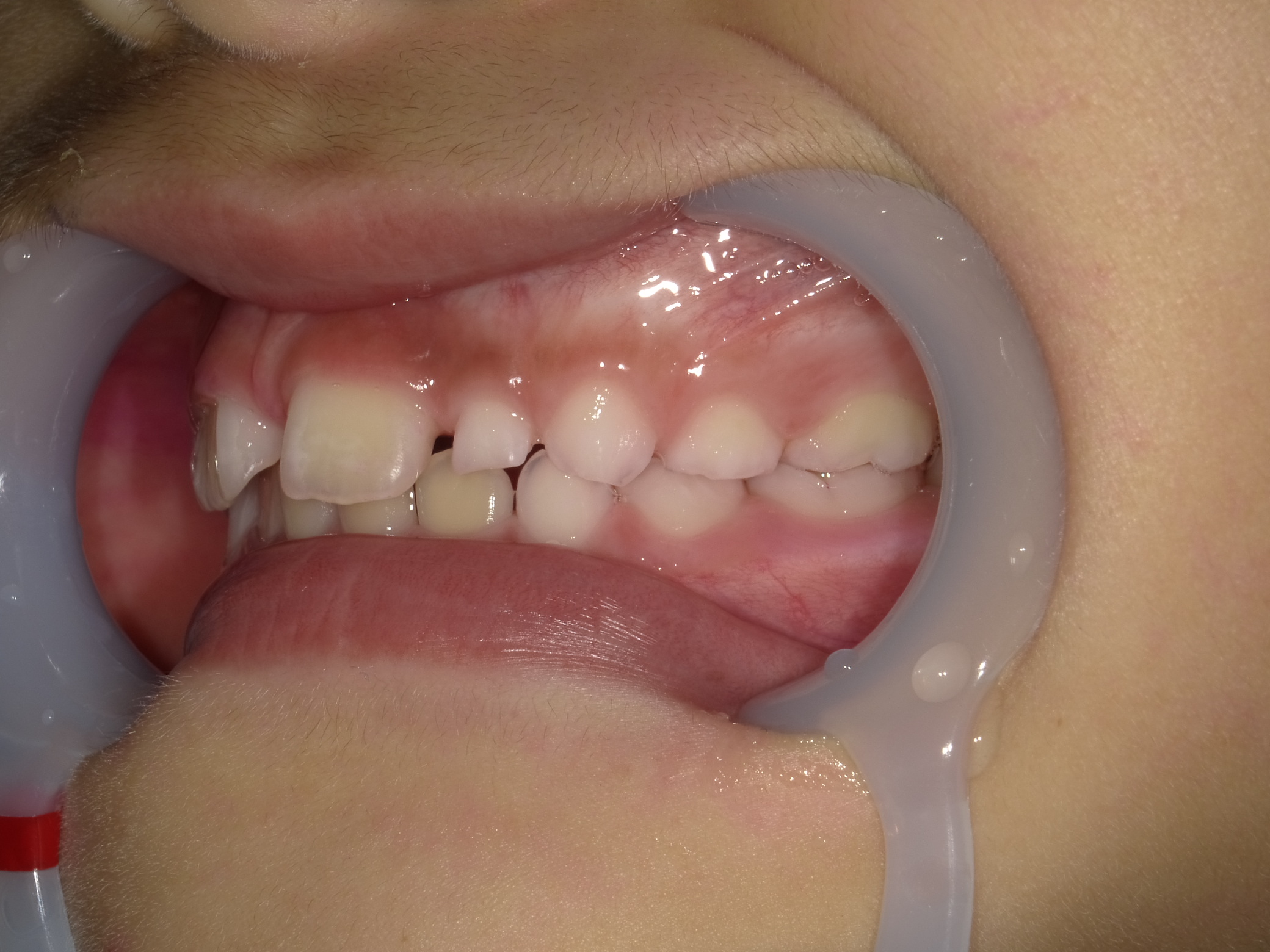 症例集　予防矯正　左横