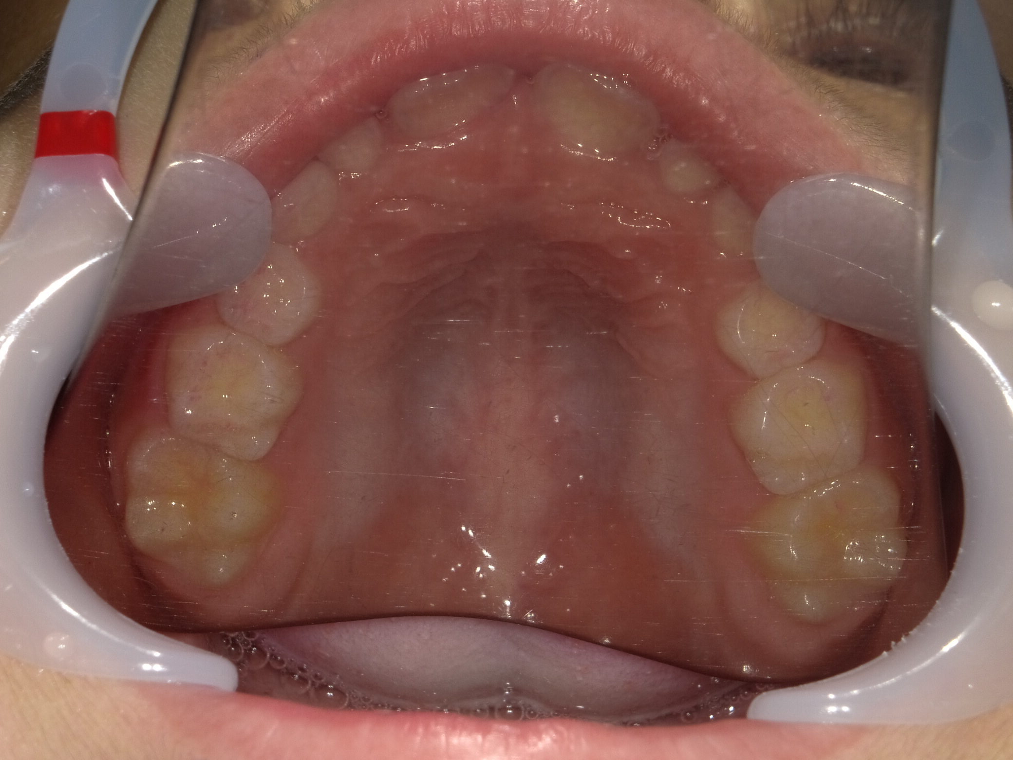 症例集　予防矯正　上顎