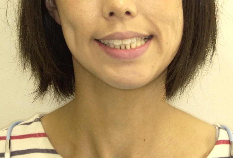 症例集 インビザライン 笑顔