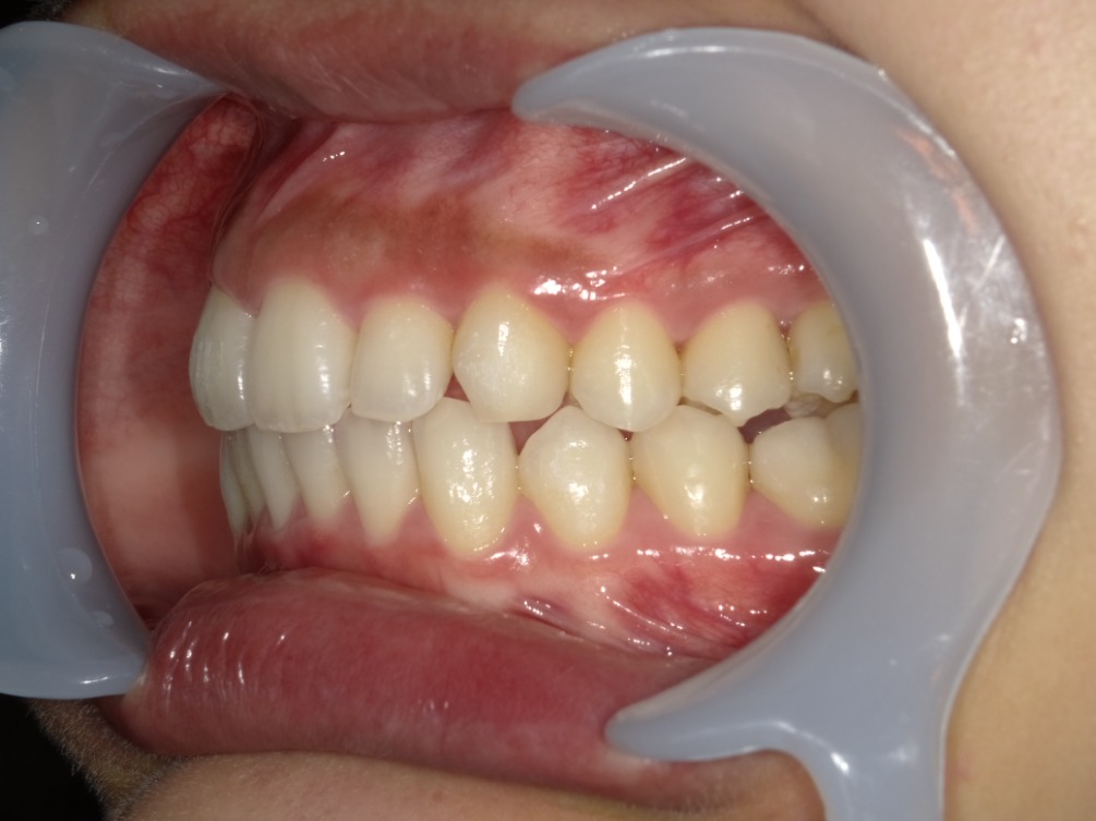 症例集 インビザライン 左横