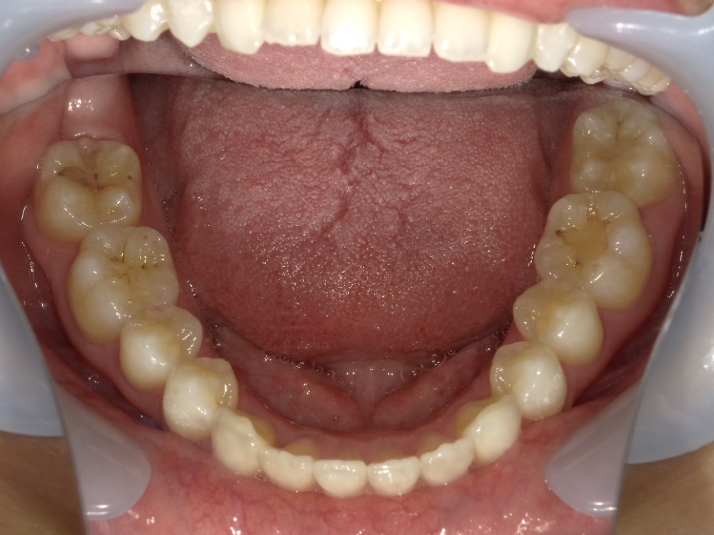 症例集 インビザライン 下顎