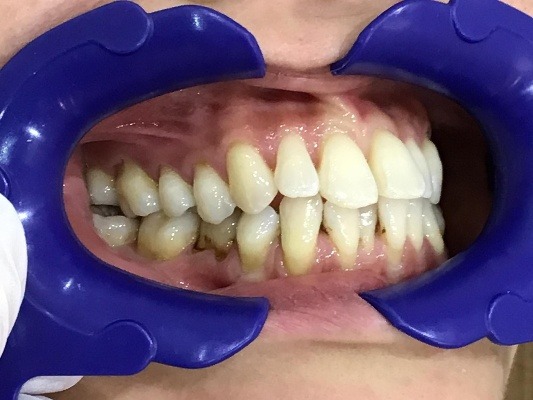 症例集 インビザライン 右横