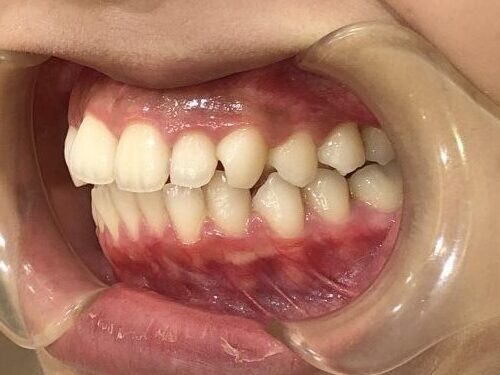 症例集 インビザライン 左横