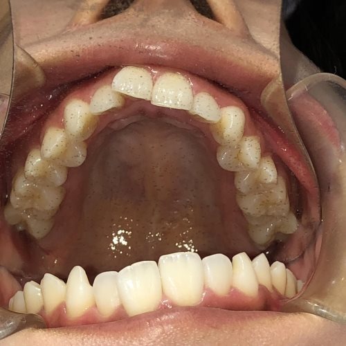 症例集 インビザライン 上顎