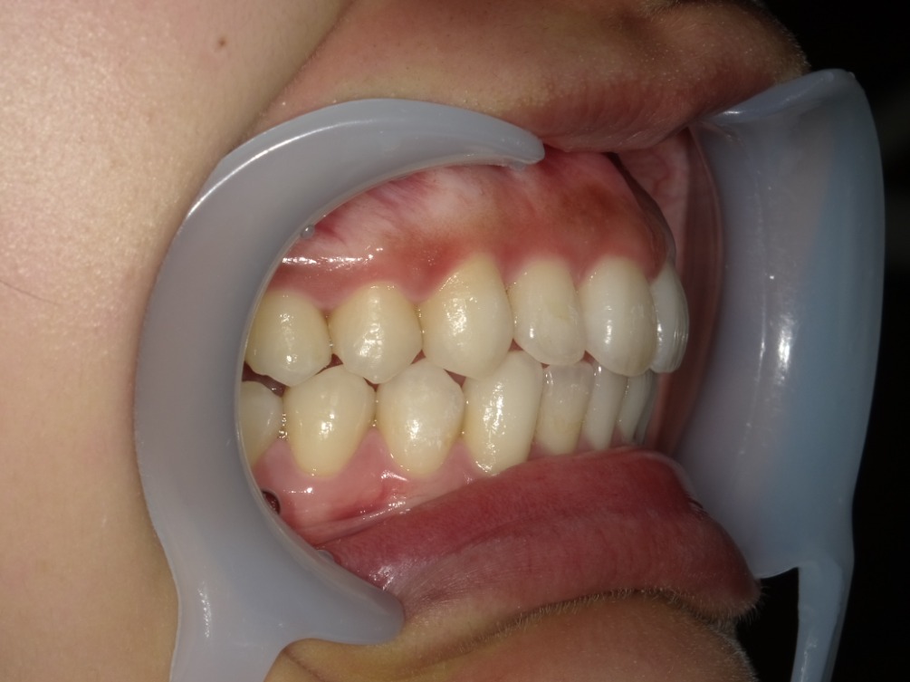 症例集 インビザライン 右横